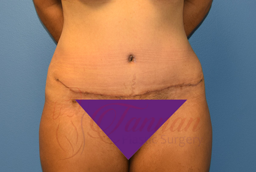 Tummy-Tuck-After-0901-Tannan-Plastic-Surgery