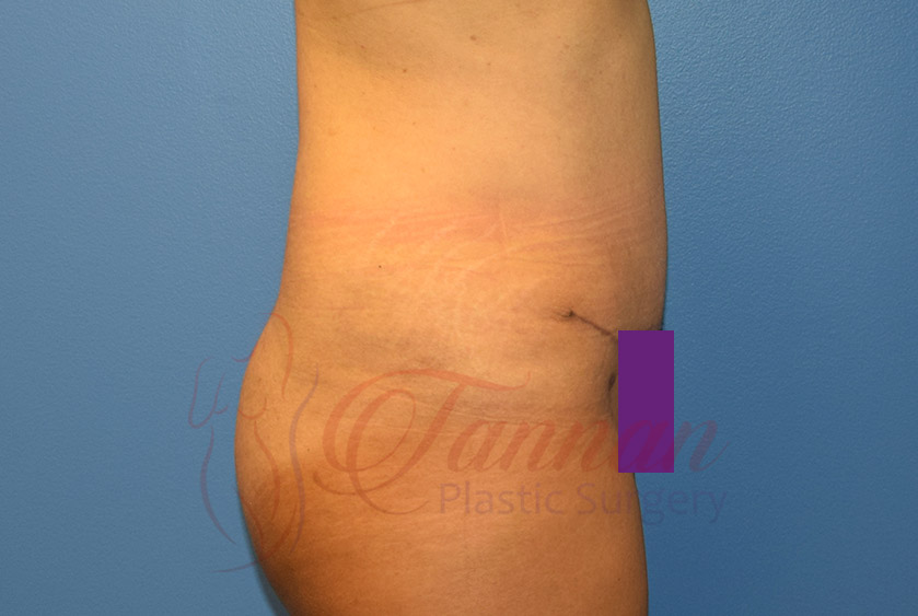 Tummy-Tuck-After-0902-Tannan-Plastic-Surgery