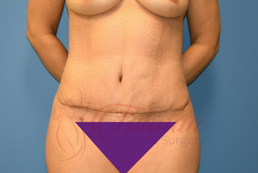 Tummy-Tuck-After-1001-Tannan-Plastic-Surgery