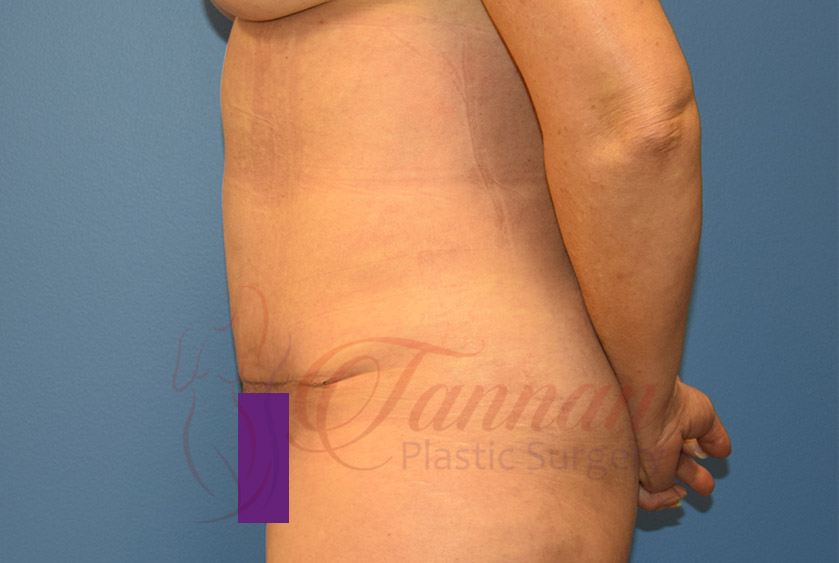 Tummy-Tuck-After-1002-Tannan-Plastic-Surgery