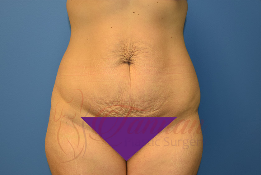 Tummy-Tuck-Before-0101-Tannan-Plastic-Surgery