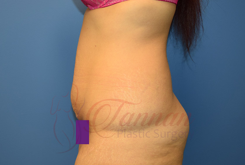 Tummy-Tuck-Before-0102-Tannan-Plastic-Surgery