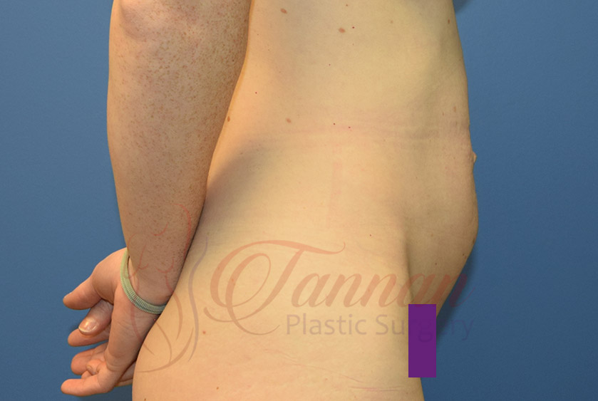 Tummy-Tuck-Before-0202-Tannan-Plastic-Surgery