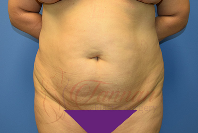 Tummy-Tuck-Before-0301-Tannan-Plastic-Surgery