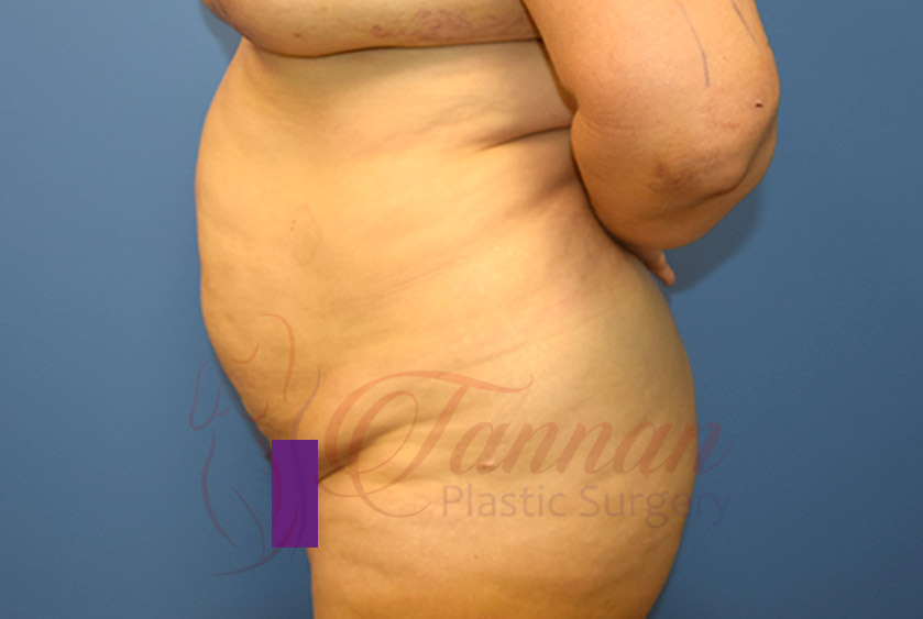 Tummy-Tuck-Before-0302-Tannan-Plastic-Surgery