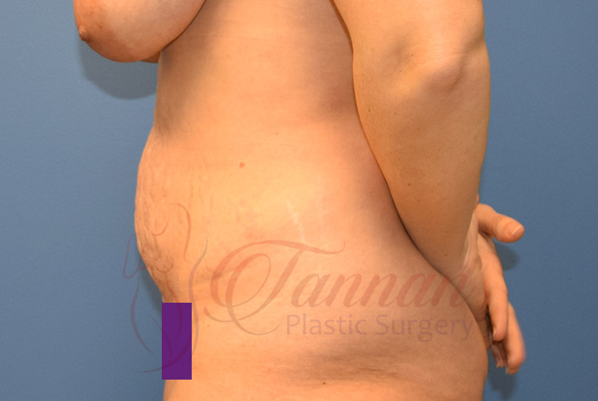 Tummy-Tuck-Before-0402-Tannan-Plastic-Surgery