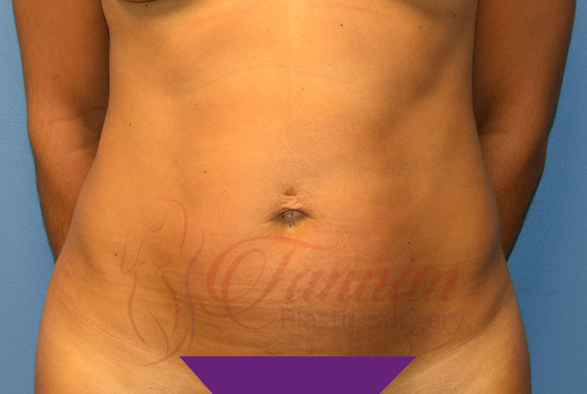 Tummy-Tuck-Before-0501-Tannan-Plastic-Surgery