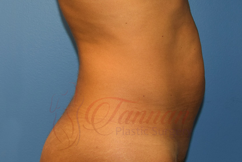 Tummy-Tuck-Before-0502-Tannan-Plastic-Surgery