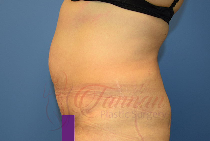 Tummy-Tuck-Before-0602-Tannan-Plastic-Surgery