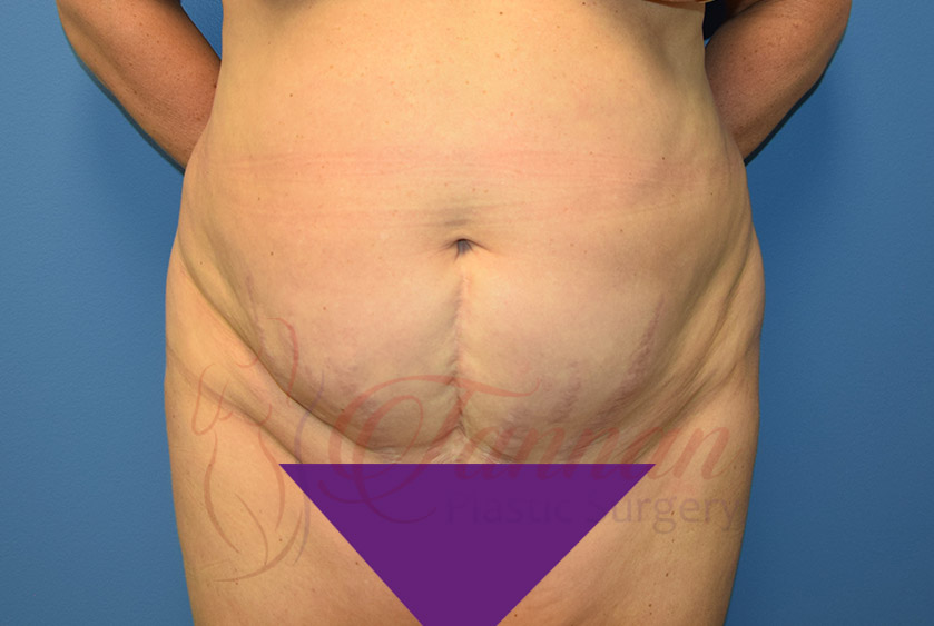 Tummy-Tuck-Before-0701-Tannan-Plastic-Surgery