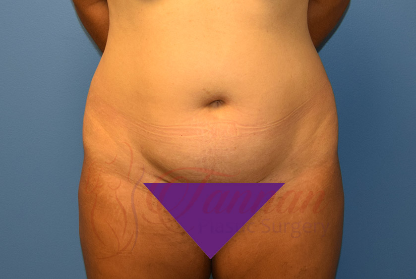 Tummy-Tuck-Before-0901-Tannan-Plastic-Surgery