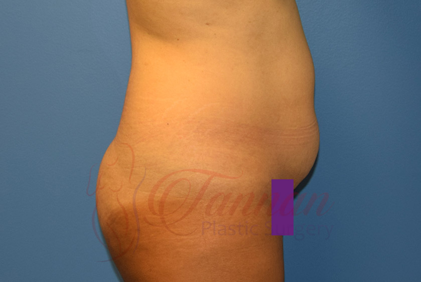 Tummy-Tuck-Before-0902-Tannan-Plastic-Surgery