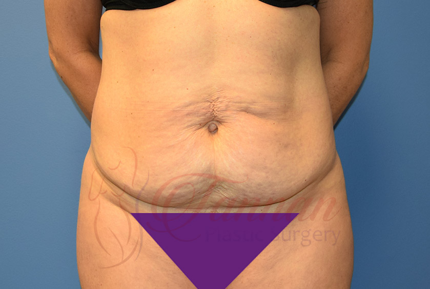 Tummy-Tuck-Before-1001-Tannan-Plastic-Surgery