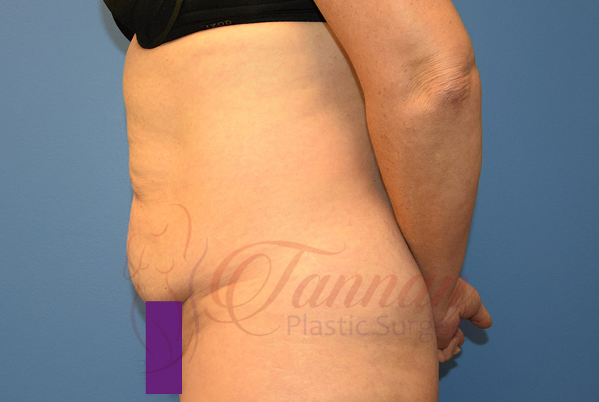 Tummy-Tuck-Before-1002-Tannan-Plastic-Surgery