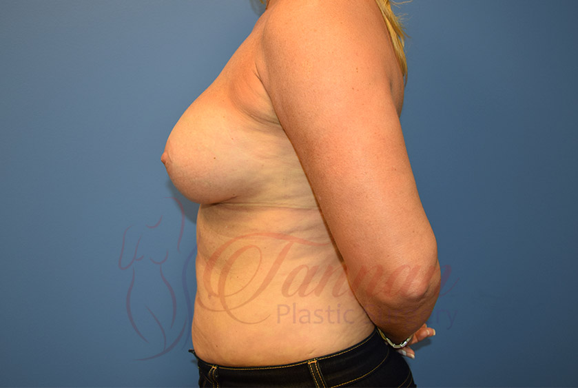 Breast-Augmentation-After-0502-Tannan-Plastic-Surgery