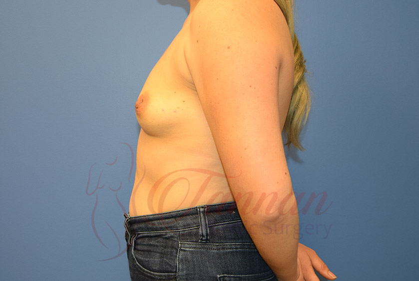 Breast-Augmentation-Before-0602-Tannan-Plastic-Surgery