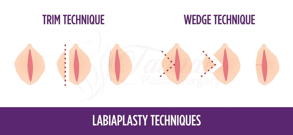 Labiaplasty Techniques - Tannan Plastic Surgery
