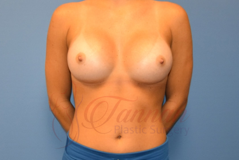 Breast-Augmentation-After-2401-Tannan-Plastic-Surgery