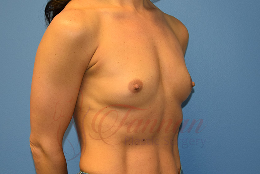 Breast-Augmentation-Before-1902-Tannan-Plastic-Surgery