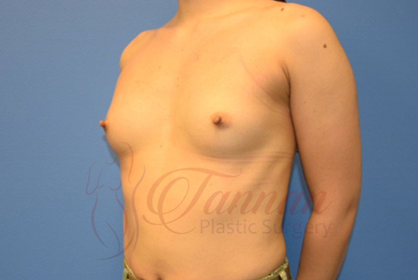 Breast-Augmentation-Before-2202-Tannan-Plastic-Surgery