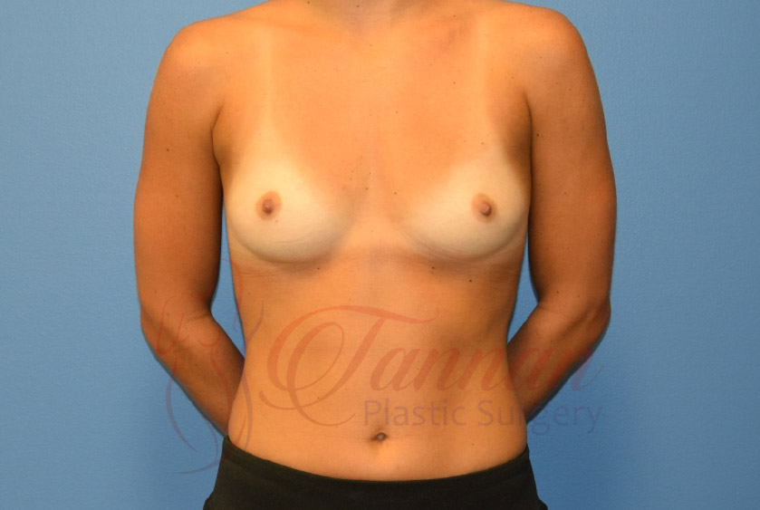 Breast-Augmentation-Before-2401-Tannan-Plastic-Surgery