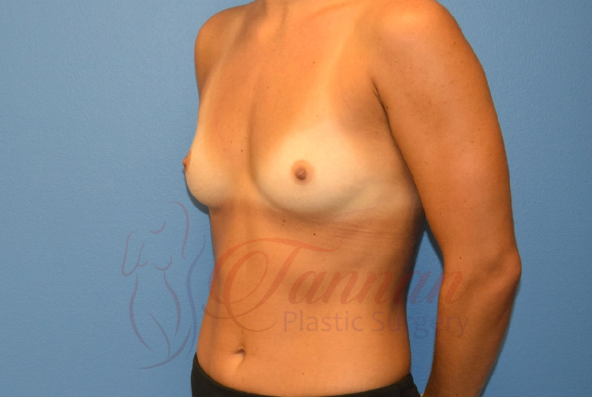 Breast-Augmentation-Before-2403-Tannan-Plastic-Surgery