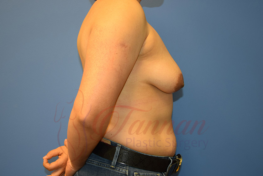 Breast-Augmentation-Before-2502-Tannan-Plastic-Surgery