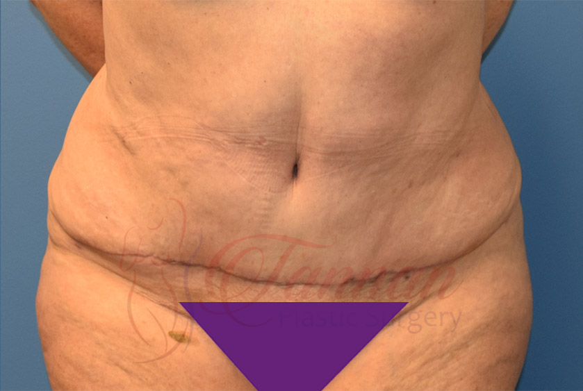 Tummy-Tuck-After-1201-Tannan-Plastic-Surgery