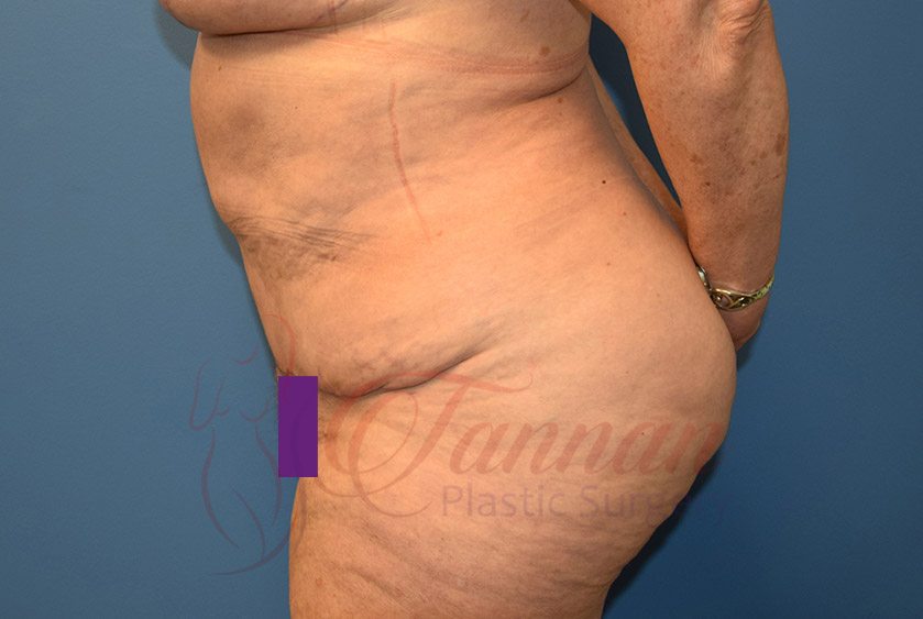 Tummy-Tuck-After-1202-Tannan-Plastic-Surgery