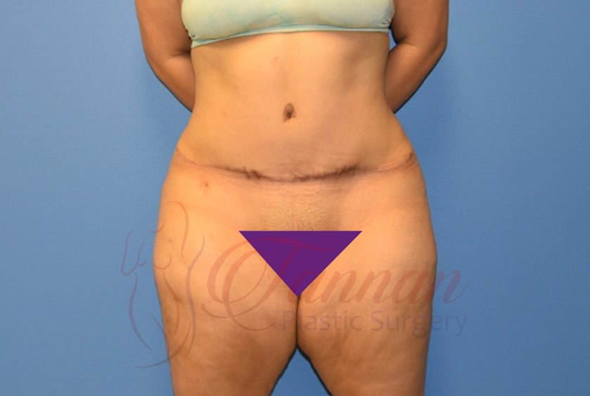 Tummy-Tuck-After-1401-Tannan-Plastic-Surgery