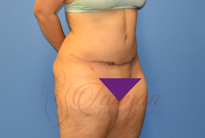 Tummy-Tuck-After-1402-Tannan-Plastic-Surgery