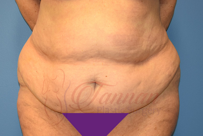 Tummy-Tuck-Before-1201-Tannan-Plastic-Surgery