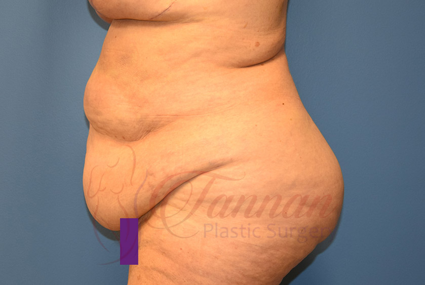 Tummy-Tuck-Before-1202-Tannan-Plastic-Surgery