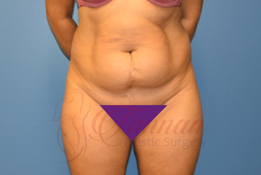 Tummy-Tuck-Before-1301-Tannan-Plastic-Surgery