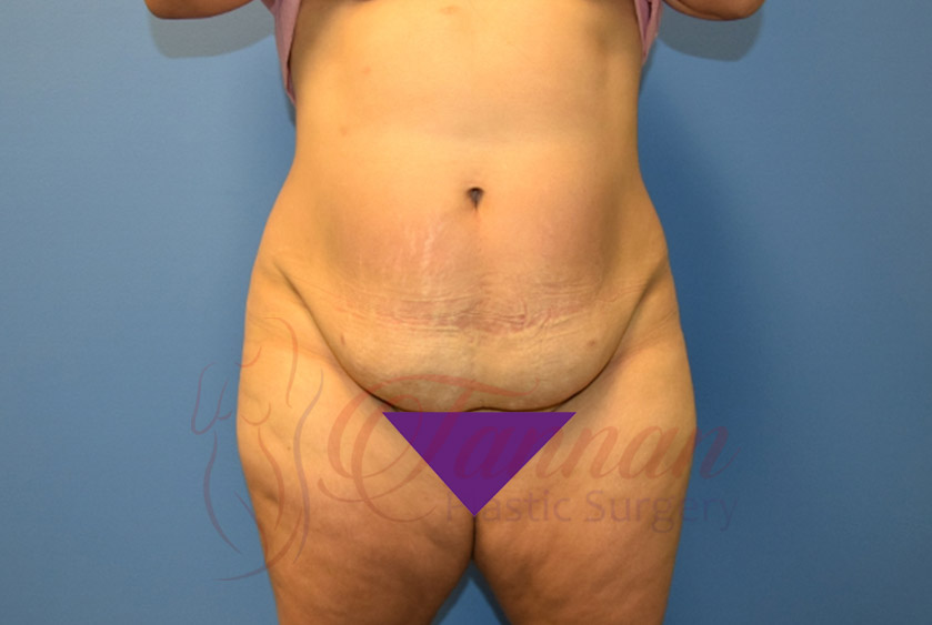 Tummy-Tuck-Before-1401-Tannan-Plastic-Surgery