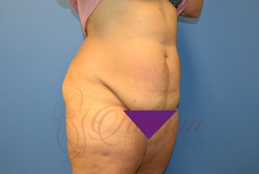 Tummy-Tuck-Before-1402-Tannan-Plastic-Surgery