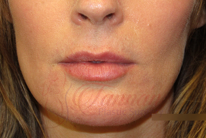 Lip Filler Migration After – following one round of Hylenex Lip Filler Migration After