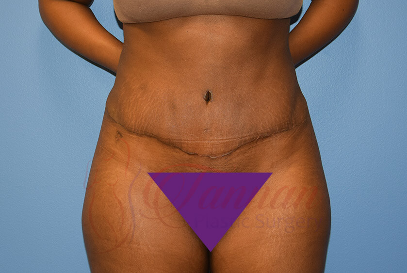 Tummy-Tuck-After-2501-Tannan-Plastic-Surgery