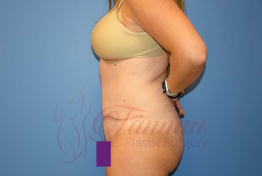 Tummy Tuck Survival Kit, Tannan Plastic Surgery