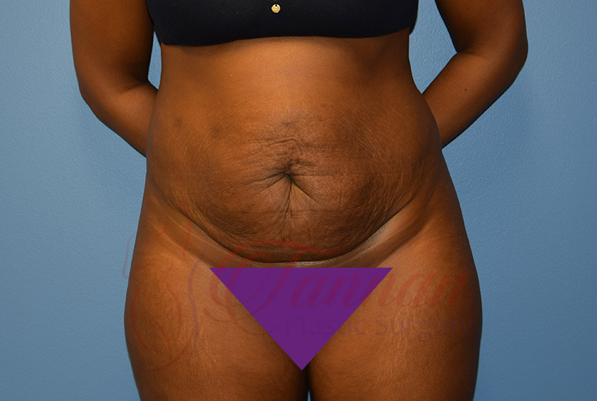 Tummy-Tuck-Before-2501-Tannan-Plastic-Surgery