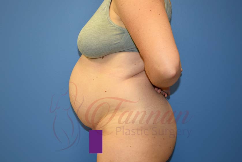 Tummy-Tuck-Before-2702-Tannan-Plastic-Surgery