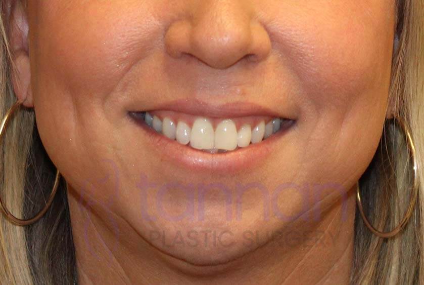 Gummy Smile After – Tannan Plastic Surgery