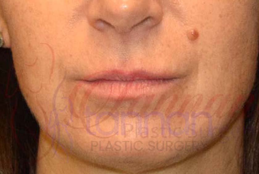 Lip Flip after 2801 – Tannan Plastic Surgery
