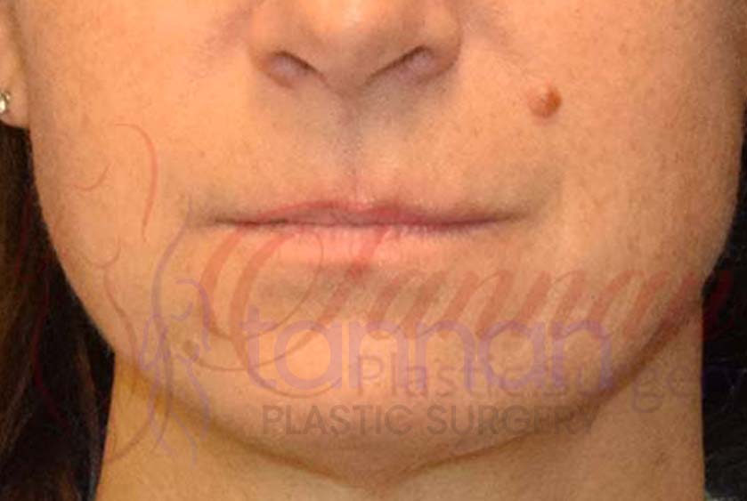 Lip Flip before 2801 – Tannan Plastic Surgery