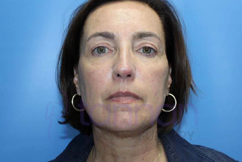 Morpheus8 After Treatment Front – Tannan Plastic Surgery