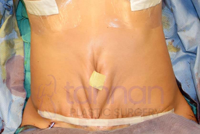 Tummy Tuck Dimples Before - Tannan Plastic Surgery