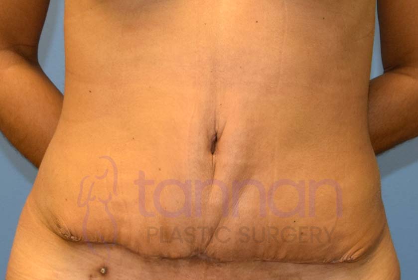 Tummy Tuck Dimples After Surgery- Tannan Plastic Surgery