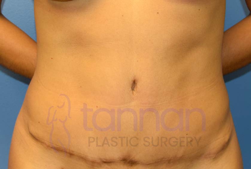 Tummy Tuck Dimples After - Tannan Plastic Surgery