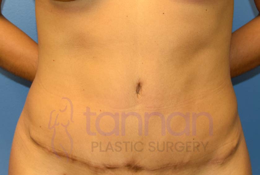 Tummy Tuck Dimples After - Tannan Plastic Surgery Tummy Tuck Dimples After - Tannan Plastic Surgery