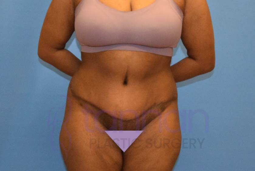 Tummy Tuck Revision Surgery Before and After